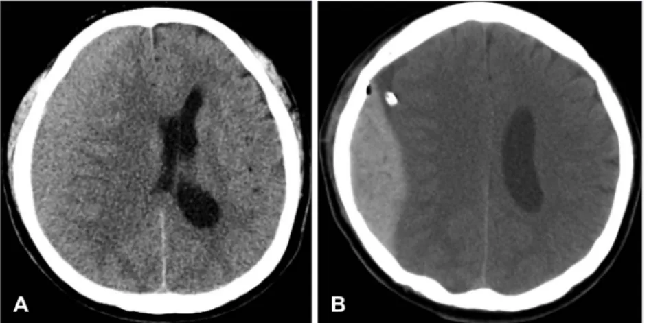 FIGURE 1. A 40-year-old man with chron- chron-ic subdural hematoma underwent burr  hole drainage