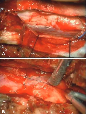 FIGURE 1. Preoperative images case 1. (A) Multi-level distortion of spinal canal and filling defect from T12 to L5 on myelogram