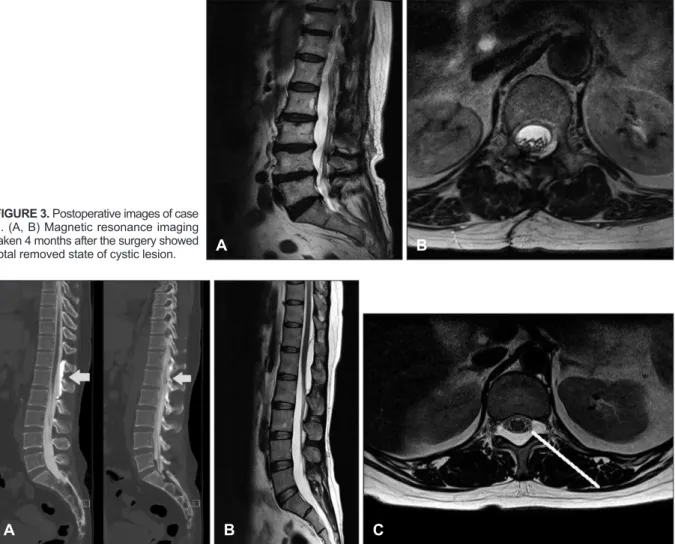 FIGURE 4. Preoperative images case 2. (A) Computed tomography myelography showed focal enhanced cystic mass that commu- commu-nicated with thecal sac at L1 level