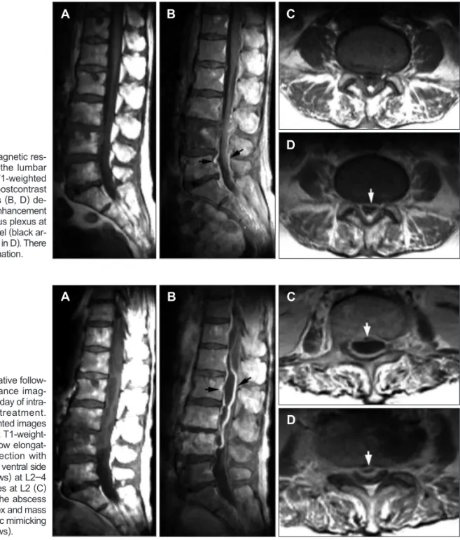 FIGURE 1. Initial magnetic res- res-onance imaging of the lumbar  spine. Precontrast T1-weighted  images (A, C) and postcontrast  T1-weighted images (B, D)  de-pict irregular, linear enhancement  in the epidural venous plexus at  L4-5 and L5-S1 level (blac