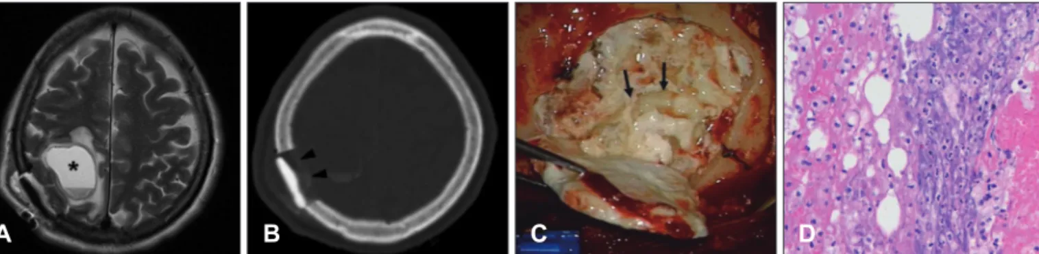 FIGURE 2. A: Swelling on previous operation site is seen (dotted line). B: Follow up brain computed tomography shows cystic le- le-sion instead of reconstructed material (white arrowheads)