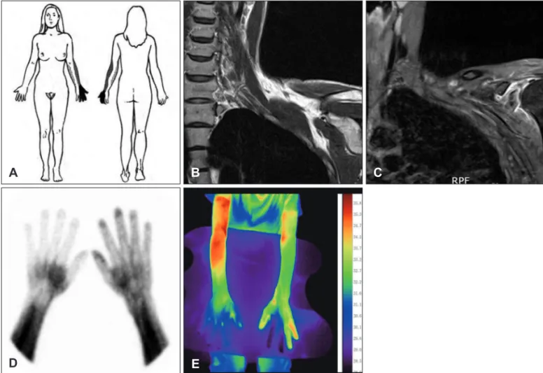 FIGURE 1. Pain distribution and magnetic resonance imaging (MRI) findings of neuralgic amyotrophy