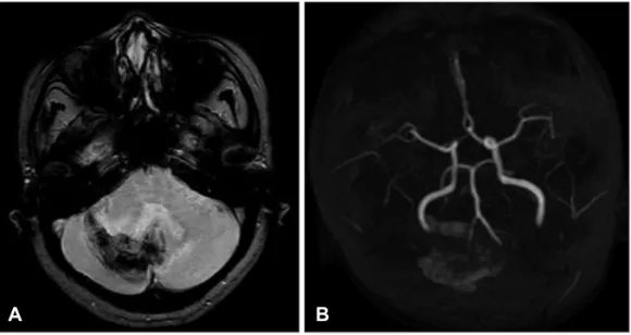 FIGURE 3. Axial plane images  of the gradient recalled echo    sequence (A) revealed a  sub-acute cerebellar hemorrhage  postoperatively