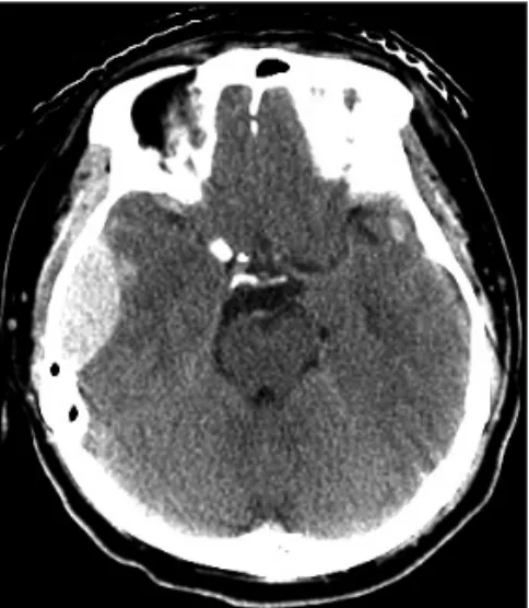 FIGURE 2. Brain MR T2 imag- imag-es showing multiple contusions  in the right temporal (A) and left  frontal regions (B).