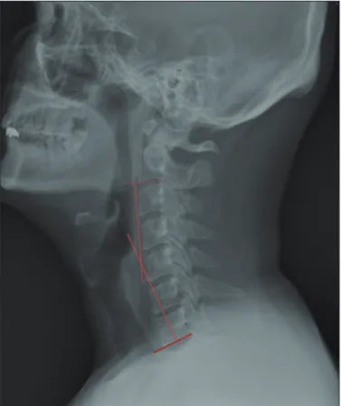 FIGURE 2. Four categories of immediate post-operative con- con-tact status between the spacer and the lamina