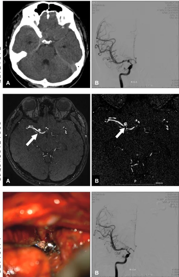 FIGURE 1. A: Brain computed  tomography image showing  su-barachnoid hemorrhage in the  right sylvian cistern