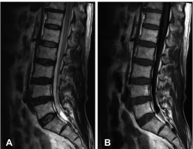 FIGURE 3. Two weeks later, follow-up sagittal T2 (A) and T1 (B)  images show markedly decreased volume and mass effect of  he-matoma.