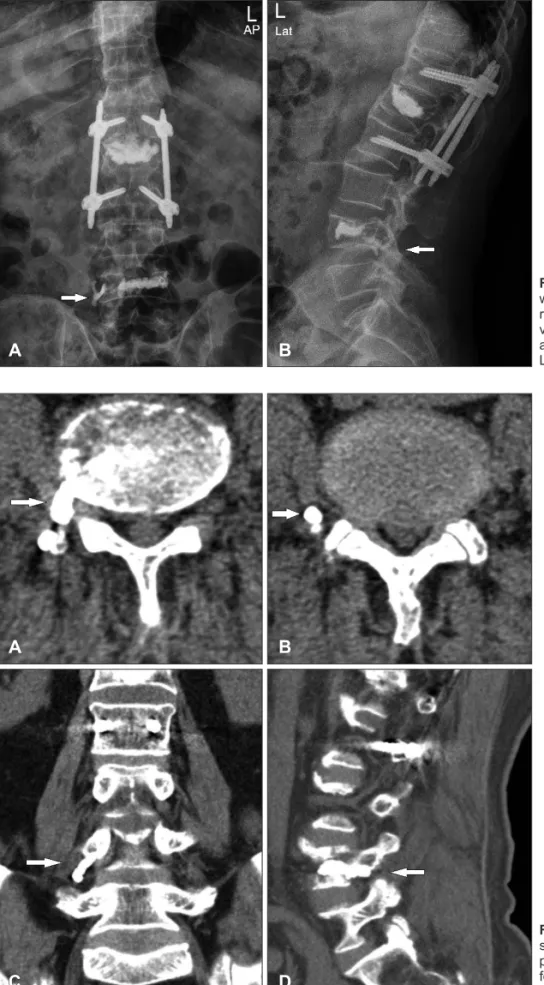 FIGURE 1. Lumbar spine plain images  were taken after L4 vertebroplasty.  Ante-rior-posterior (AP) view (A) and lateral  view (B) show that cement leakage spread  along the posteroinferolateral margin of  L4 vertebra (arrow).