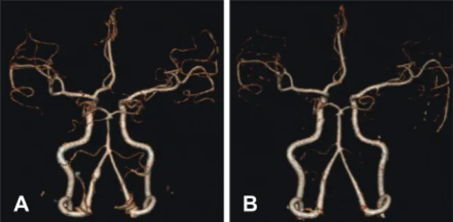 FIGURE 2. Case 4. A 56-year-old male with headache after a physical fight. A: Initial CTA showing fusiform aneurysm at left distal  vertebral artery