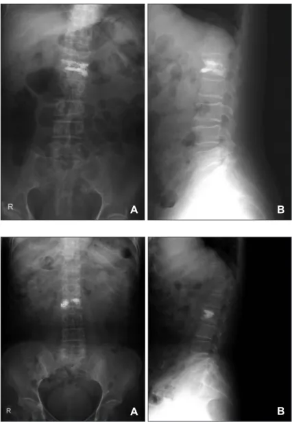 FIGURE 1. Postoperative anteroposterior (A)  and lateral (B) plain X-ray show evenly  distrib-uted cement in vertebral body.
