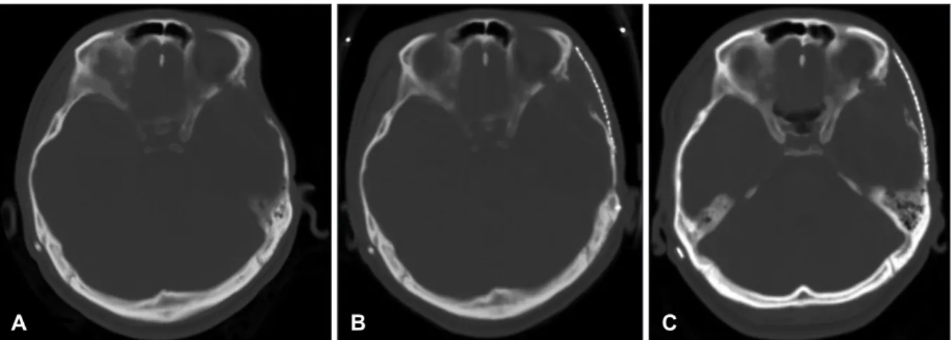 FIGURE 1. Sequential brain computerized tomography (CT) scan. A: Before the surgery for temporal hollowing, the left temporal  area shows a defect compared to the right temporal area, because of previous temporal muscle resection