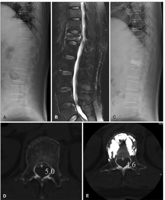 FIGURE 1. A: 73-year-old female patient had a burst fracture of T12 on initial plain film
