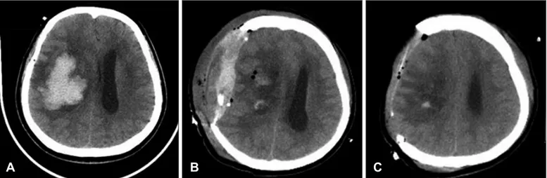 FIGURE 1. Results of computed tomography (CT) examinations. A: CT scan showing intracranial hematoma at right basal ganglia  with midline shifting