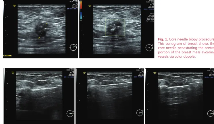 Fig. 1. Core needle biopy procedure,  This sonogram of breast shows the  core needle penestrating the central  portion of the breast mass avoiding  vessels via color doppler.