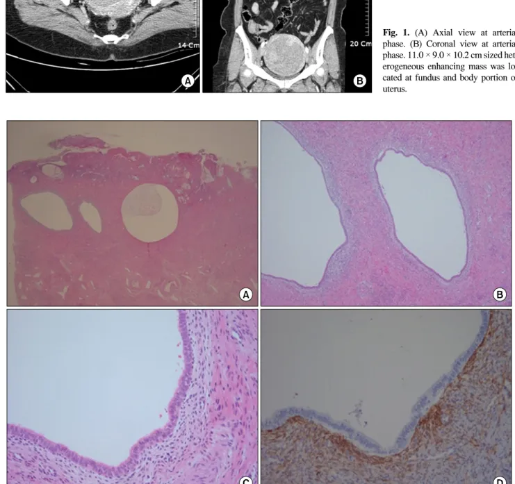 Fig.  1.  (A)  Axial  view  at  arterial  phase.  (B)  Coronal  view  at  arterial  phase