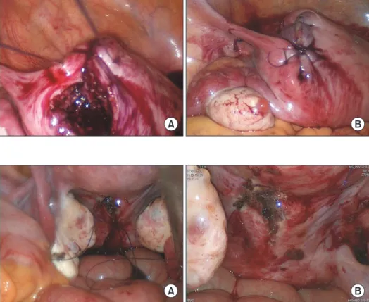 Fig. 1. (A) and (B) Interrupted suture  technique with figure of 8 in single  port laparoscopic myomectomy.