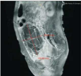 Fig. 1. About 15 cm sized huge cystic mass in lower abdomen  with ascites (computed tomography).