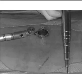 Fig. 1. A 26-mm-diameter tubular retractor in position.