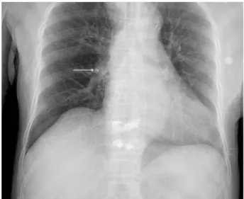 Fig. 4. An immediate postoperative chest radiograph shows high density cement embolus in right lung hilar area (arrow)