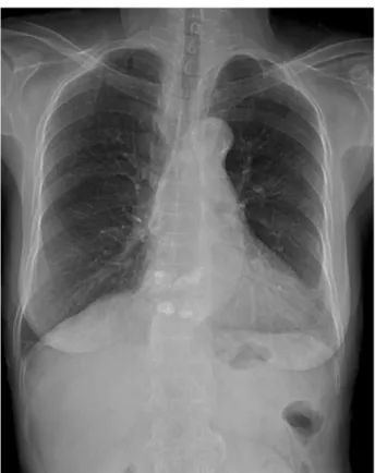 Fig. 6. A postoperative 1 year radiograph shows no interval change with an immediate postoperative chest  radi-ograph.