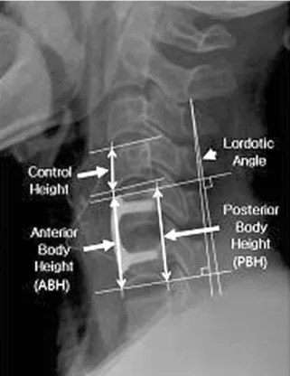 Table 2. Change of local lordosis and body height between two groups