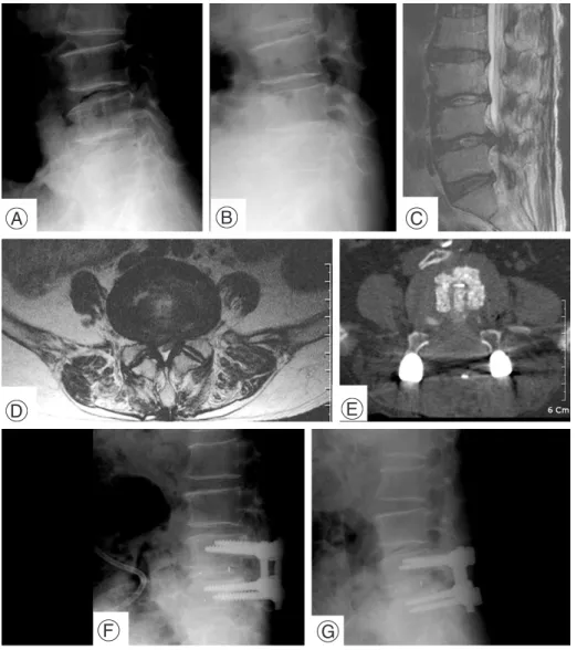 Fig. 1. The Lateral flexion and extension radiographes show L45 angular instability (A, B) and sagittal and axial T2 WI of MRI show the stenotic lesion (C, D)
