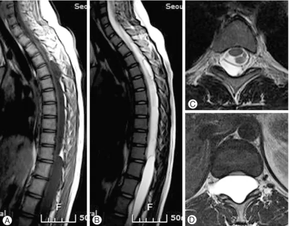 Fig. 1. Preoperative sagittal T1-weighted (A) and T2-weighted (B) spine MR images demonstrating exten- exten-sive cystic lesion causing spinal cord compression
