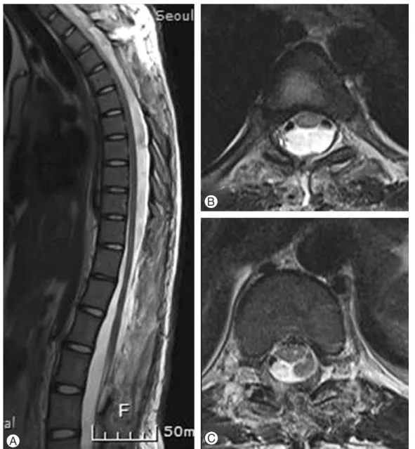 Fig. 4. Sagittal T2-weighted (A) and Axial T2-weighted (B, C) MR images obtained 2 weeks postopera- postopera-tively demonstrating expanded spinal cord, complete excision of multiple extradural arachnoid cysts.