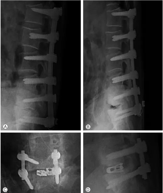 Fig. 2. Reoperation in case of pseudoarthrosis 70-year-old man with PLF for spinal stenosis L1-2, 2-3, 3-4, 4-5, L5- L5-S1 (A), (B): Dynamic view showing angular motion on L5-L5-S1