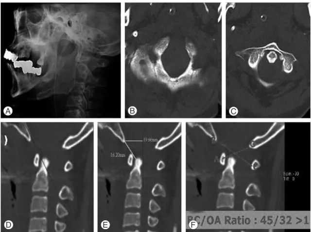 Fig. 2. Initial lateral cervical spine radiograph and CT scan suggests atlanto-occipital dislocation