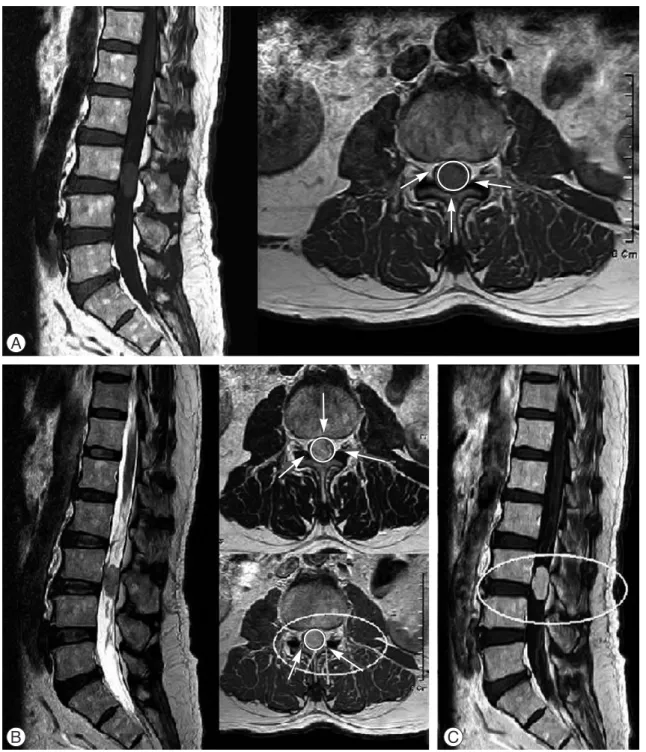Fig. 1. MRI images indicate an intradural extramedullary mass at L3. (A) T1-weighted MRI image shows hyperinten- hyperinten-sity relative to the surrounding spinal fluid