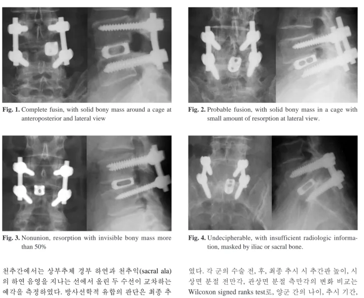 Fig. 3. Nonunion, resorption with invisible bony mass more than 50%