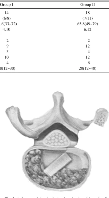 Fig. 1. Various instruments are utilized to thoroughly clean the disc and cartilaginous endplate from the disc space.