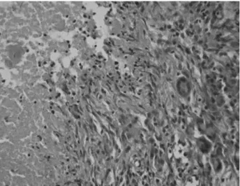 Fig. 2. Histologic finding shows caseous necrosis with chronic granulated inflammation (H-E×100).