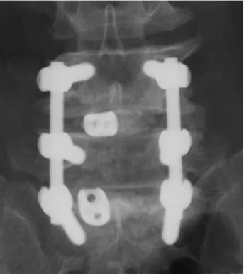 Fig. 1. PLIF with pedicle screws and one cage augmented with local bone chips.