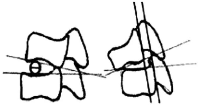 Fig. 2. Changes in the motion segment between vertebrae. Cal- Cal-culation of the angular displacement of the flexion/