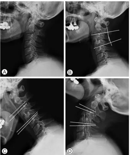 Fig. 3. A 42-year-old woman, disc herniation at C3-4 and treated with anterior cervical disectomy and fusion