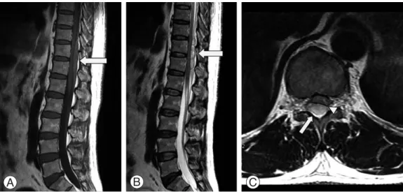 Fig. 1. Sagittal MRI obtained in a 48-year-old mas suffering from sudden onset back pain and sensorimotor paralysis