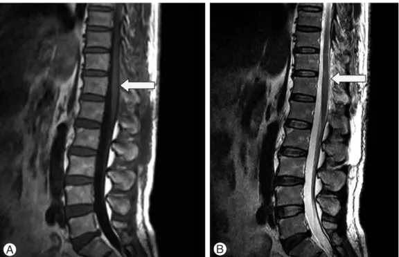 Fig. 2. Partial hemilaminectomy from T10 to L2 is done at left side. (A) The epidural hematoma was visible under the sublaminar space (yellow arrow) that compressed the dural sac