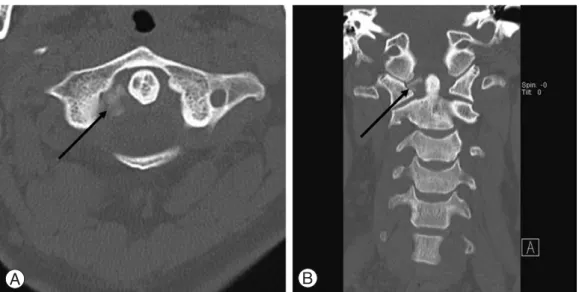 Fig. 2. Patterns of calcifications according to localization and extent in relation to the odontoid process of the axis on computed tomography scans