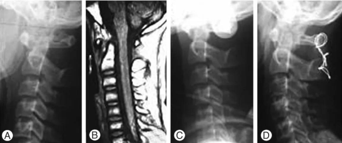 Fig. 1. 17 year-old man sustainted a type IIb occitocervical dislocation in motor vehicle accident