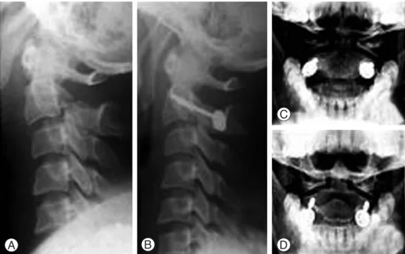 Fig. 6. (A) The patient sustained type IIA traumatic spondylolisthesis of the axis. (B) Transpedicular fixation was achieved, allowing immediate mobilization in a collar