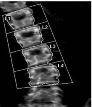 Fig. 1. The DEXA of lumbar vertebra was taken after correcting the 2nd one as a neutral portion to decrease errors caused by rota- rota-tional deformity in scoliosis.