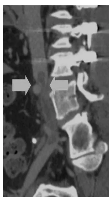 Fig. 4. CT venogram shows compression of left common iliac vein by right common iliac artery.