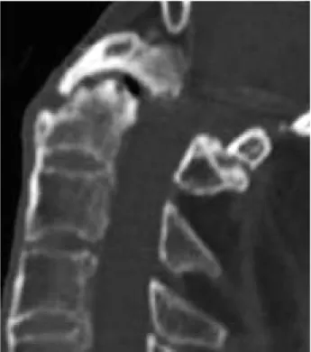 Fig. 4. Final follow up x-ray shows the well-fused C0-2 level.