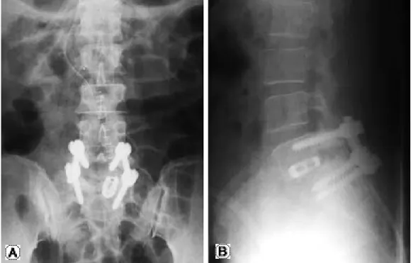 Fig. 1. (A, B) After the first operation, plane radiographs showed that a right-sided cage violated upper end plate.