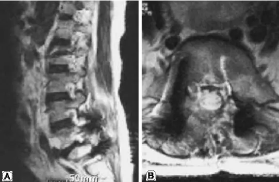 Fig. 2. (A, B) T2-weighted MR image showed no causative mass for the left-sided foot drop.