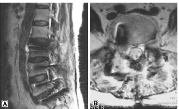 Fig. 4. (A, B) T2-weighted MR image showed no causative mass for the left-sided foot drop.