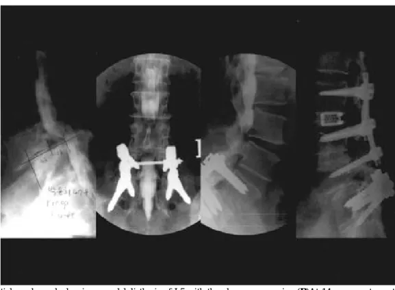 Fig. 1. (A)Initial myelograph showing spondylolisthesis of L5 with thecal sac compression (B)At 14 years postoperatively, myelo- myelo-graphs show a narrowing of spinal canal above fusion segment