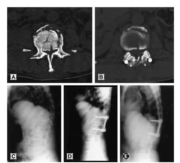 Table 4. Change of kyphotic angle according to McCormack's load sharing classification in 86 patients with short segment instru- instru-mentation and fusion
